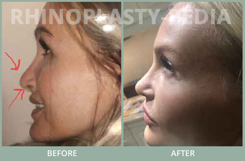 rhinoplasty female patient before and after photo set 76