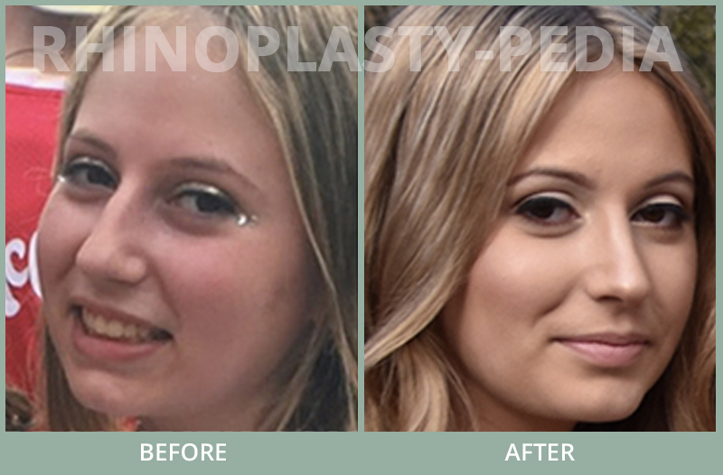 rhinoplasty female patient before and after photo set 65