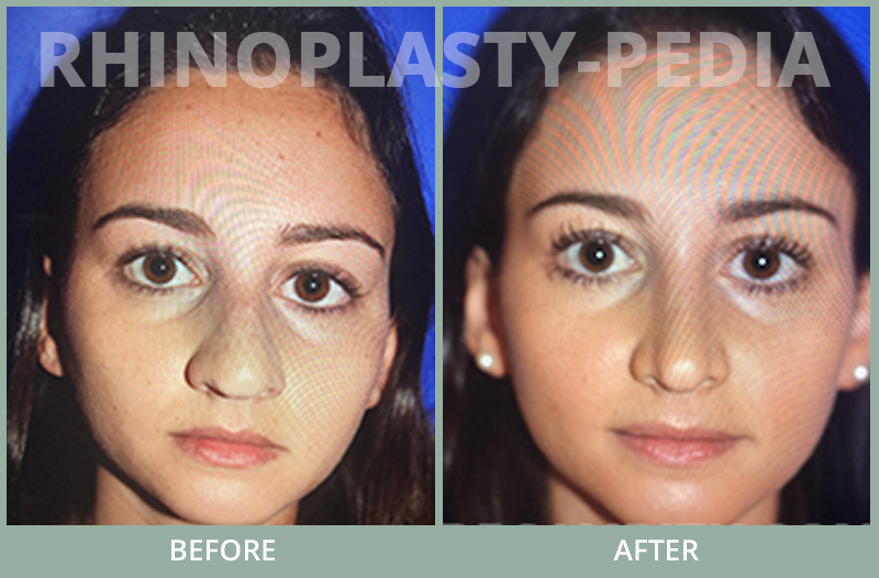 rhinoplasty female patient before and after photo set 77