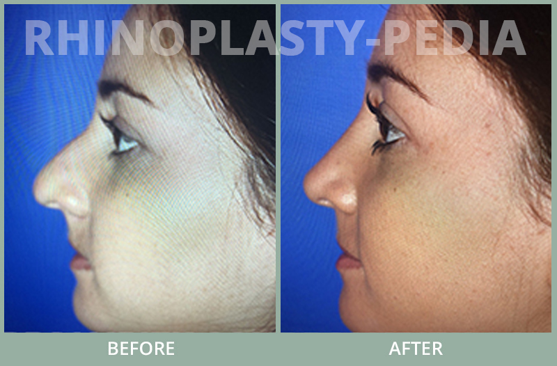 rhinoplasty female patient before and after photo set 77