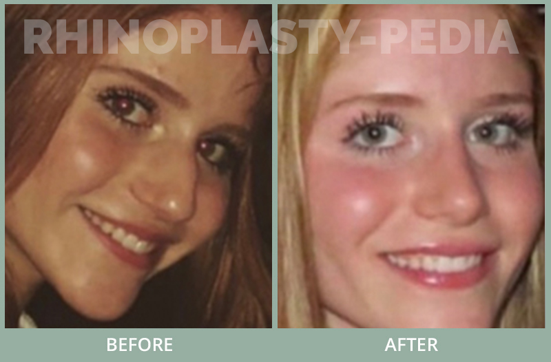 male rhinoplasty patient before and after photo 83