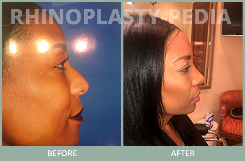 rhinoplasty female patient before and after photo set 66