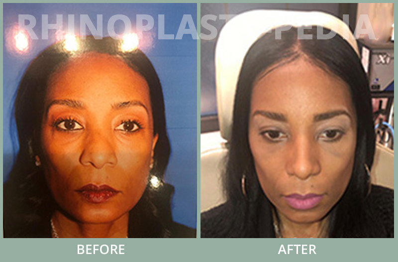 rhinoplasty female patient before and after photo set 66