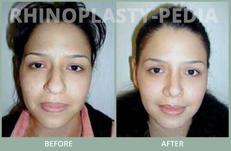 rhinoplasty female patient before and after photo set 69