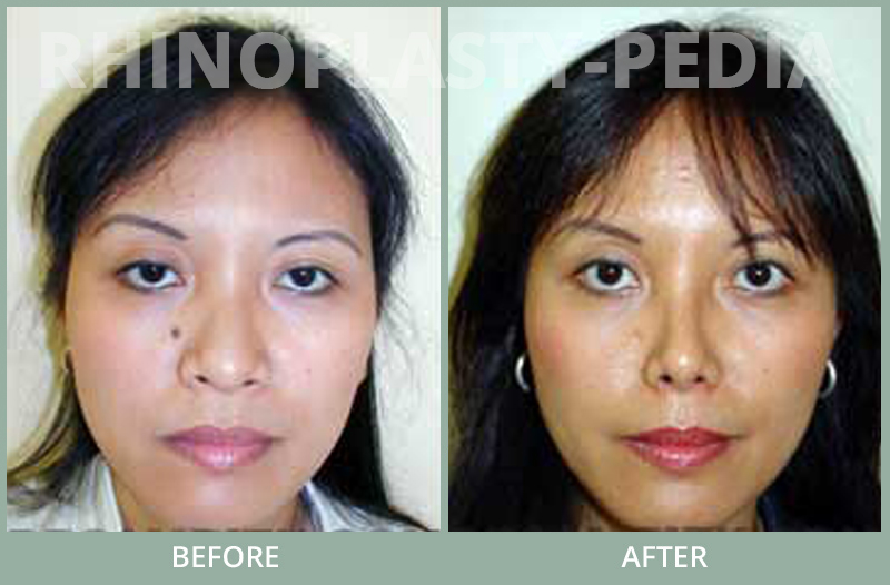 rhinoplasty female patient before and after photo set 70