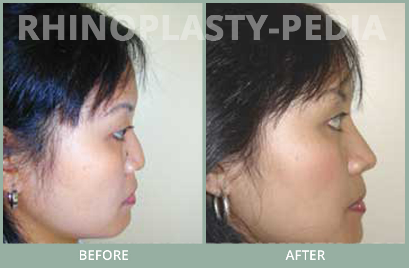 rhinoplasty female patient before and after photo set 70