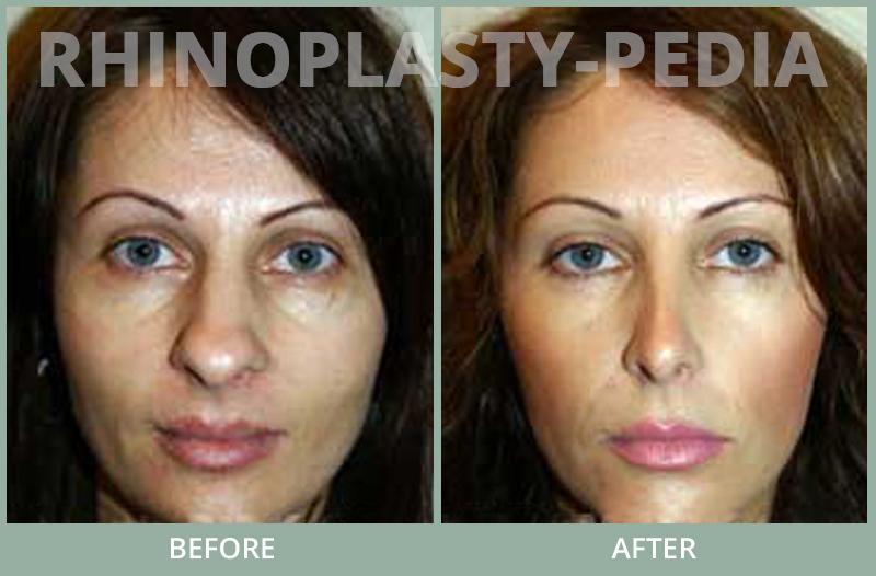 rhinoplasty female patient before and after photo set 71