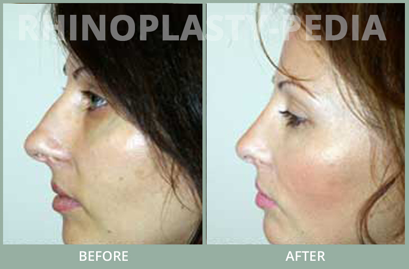 rhinoplasty female patient before and after photo set 71