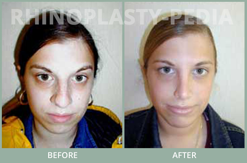 rhinoplasty female patient before and after photo set 72