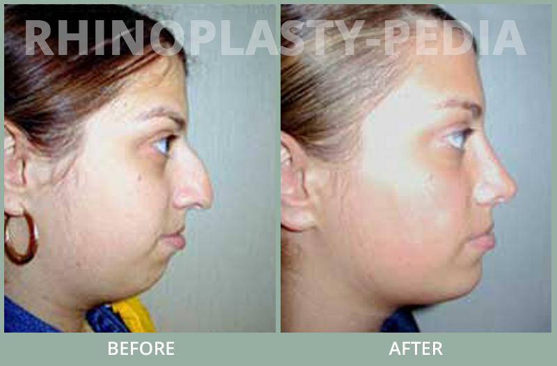 rhinoplasty female patient before and after photo set 72