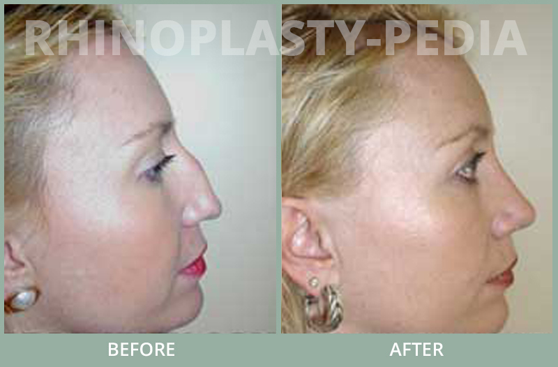 rhinoplasty female patient before and after photo set 73