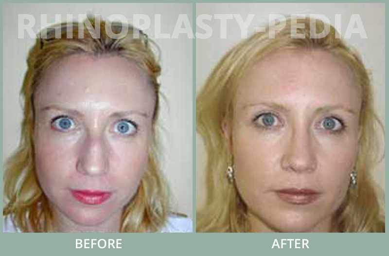rhinoplasty female patient before and after photo set 73