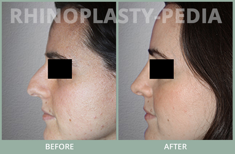 rhinoplasty female patient before and after photo set 74