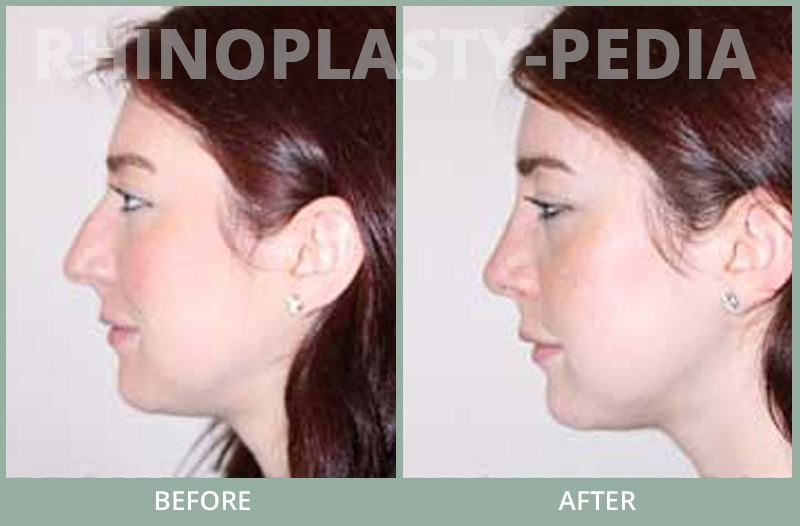 male rhinoplasty patient before and after photo 68