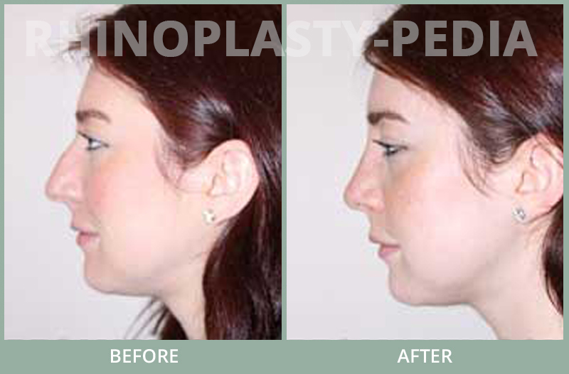 rhinoplasty female patient before and after photo set 68