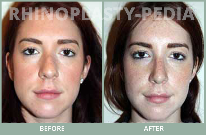 rhinoplasty female patient before and after photo set 68