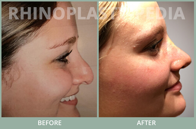 rhinoplasty female patient before and after photo set 78