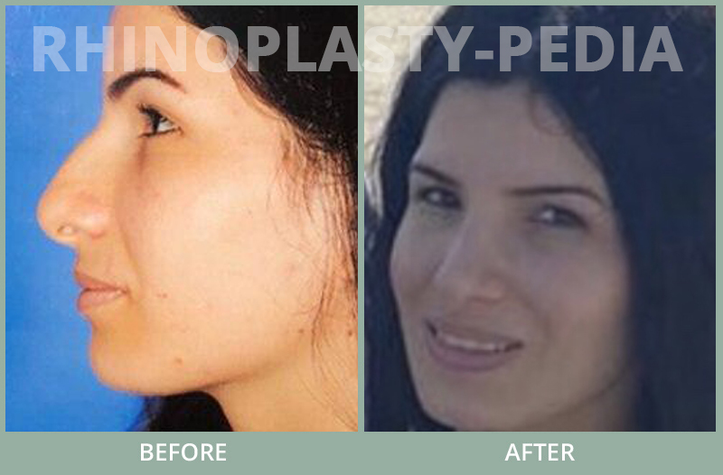 rhinoplasty female patient before and after photo set 67