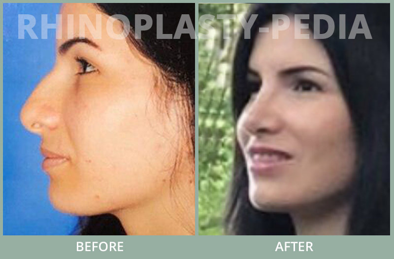 rhinoplasty female patient before and after photo set 67