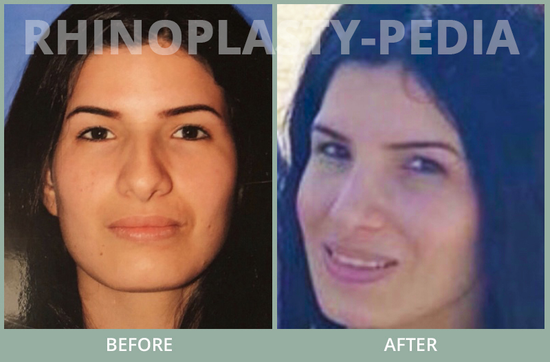 rhinoplasty female patient before and after photo set 67