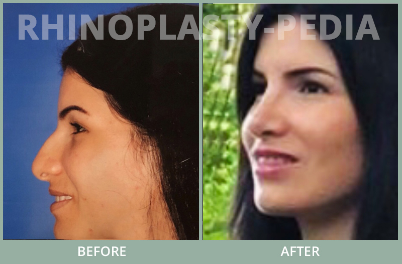 rhinoplasty female patient before and after photo set 67