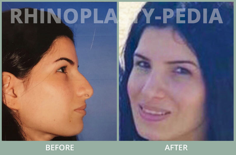 rhinoplasty female patient before and after photo set 67