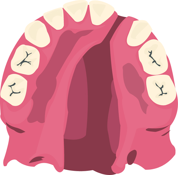 Rhinoplasty Combined with Cleft Lip Deformity