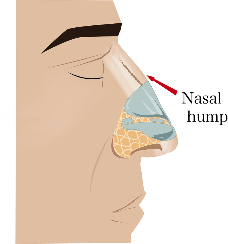 techniques in male rhinoplasty - nasal hump photo