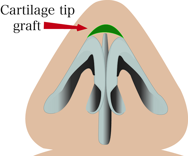cartilage tip graft photo