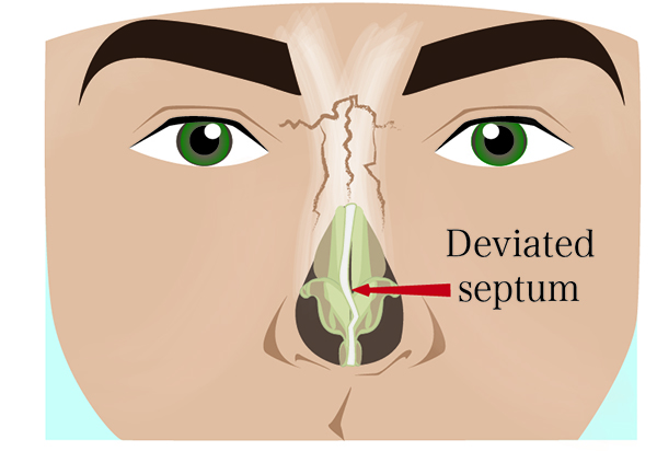 deviated septum photo