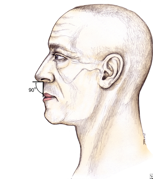 rhinoplasty for a drooping Nose - Nasolabial angle