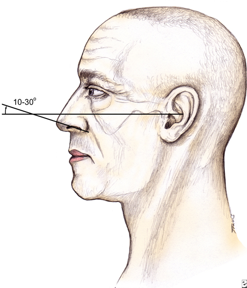 rhinoplasty for a drooping Nose - Frankfort plane and nasal rim angle photo