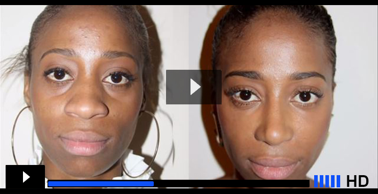 african american rhinoplasty video banner photo