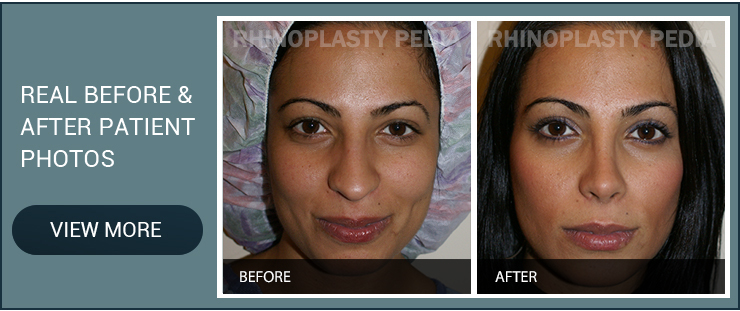 refining or reducing a nasal hump real before and after patient photo