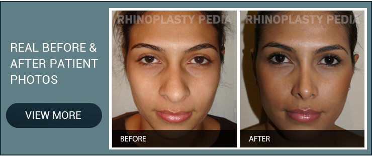 narrowing the nostrils real before and after patient photo