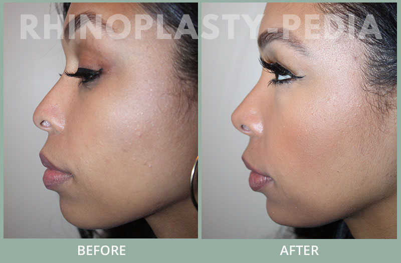 frhinoplasty female patient before and after photo set 69