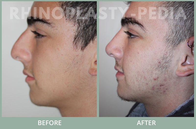 rhinoplasty male patient before and after photo set 24