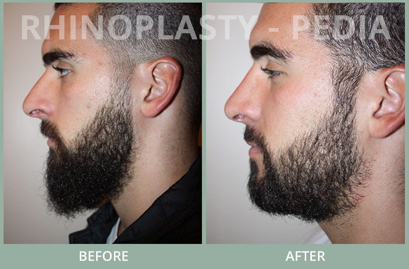 rhinoplasty male patient before and after photo set 24