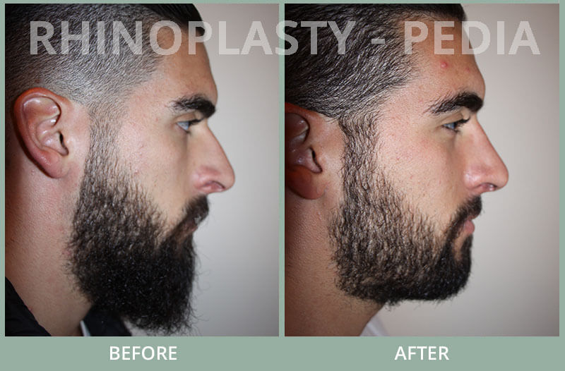 rhinoplasty male patient before and after photo set 24