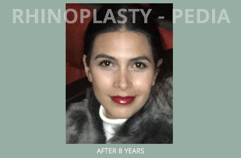 rhinoplasty female patient before and after photo set 20