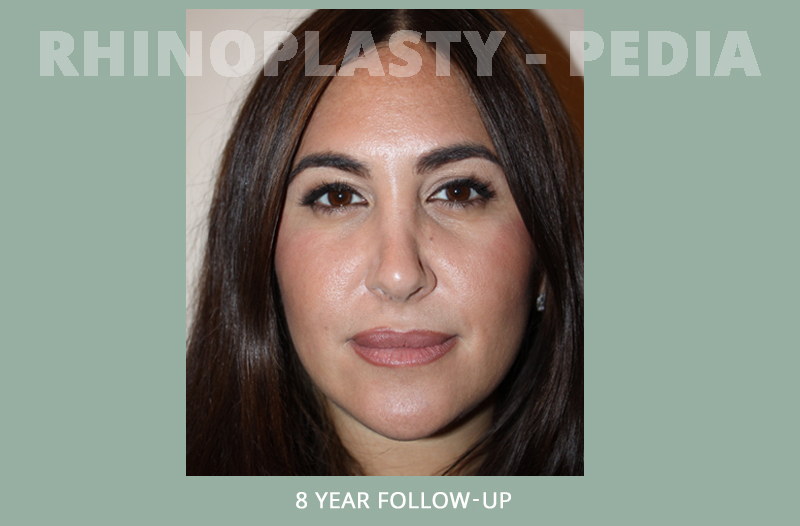 female rhinoplasty patient before and after photo 6