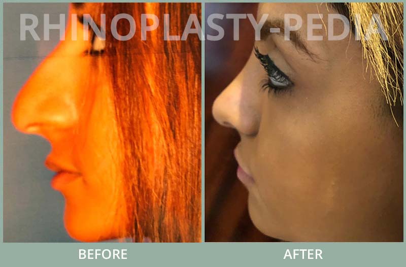rhinoplasty female patient before and after photo set 111
