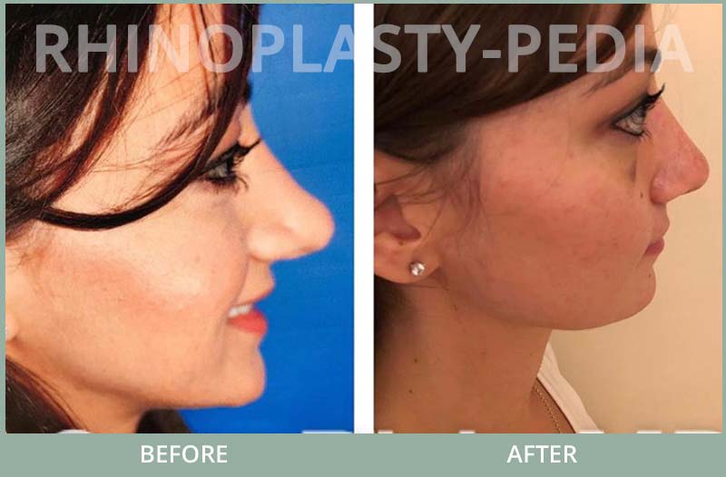 female rhinoplasty patient before and after photo 8