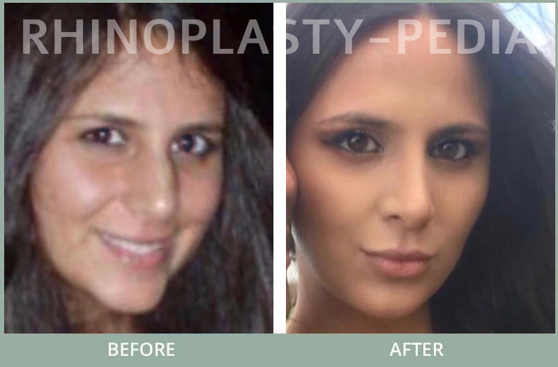 rhinoplasty female patient before and after photo set 112