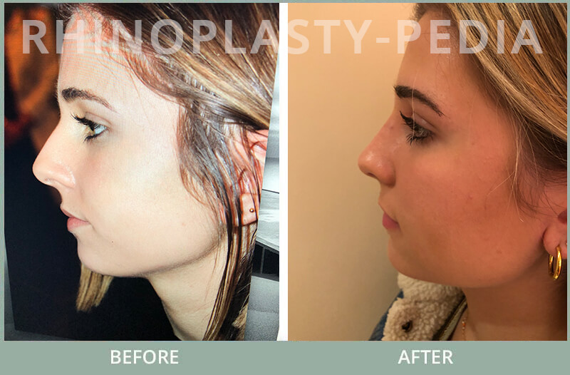 rhinoplasty female patient before and after photo set 112