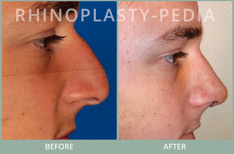 rhinoplasty male patient before and after photo set 24