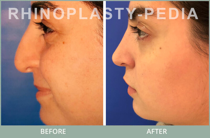 female rhinoplasty patient before and after photo 8