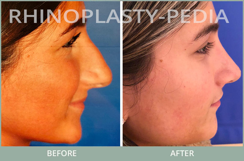 rhinoplasty female patient before and after photo set 112