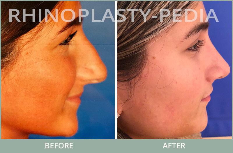 female rhinoplasty patient before and after photo 8