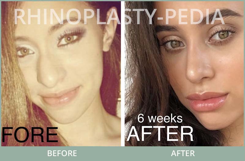 rhinoplasty female patient before and after photo set 112